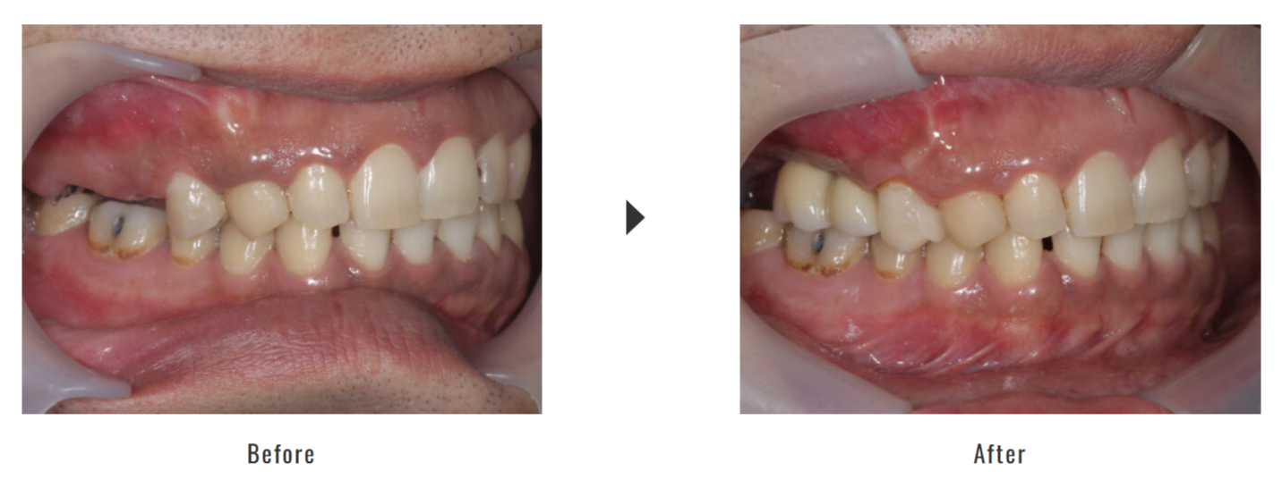 サイナスリフト＋GBRの症例